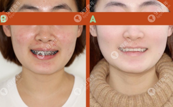 推磨牙矫正可以使用金属托槽吗 推磨牙矫正可以使用金属托槽吗