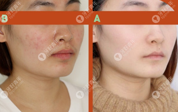 整牙可以改善上唇嘴突吗？22岁的我通过后推磨牙矫正做到了