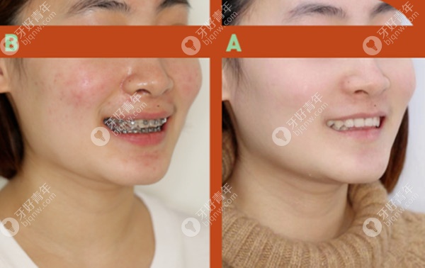 金属托槽推磨牙矫正可以改善露龈笑吗 金属托槽推磨牙矫正可以改善露龈笑吗