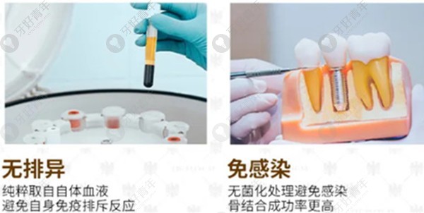 震惊!65岁阿姨用德国生长因子技术15分钟做了3颗种植牙。