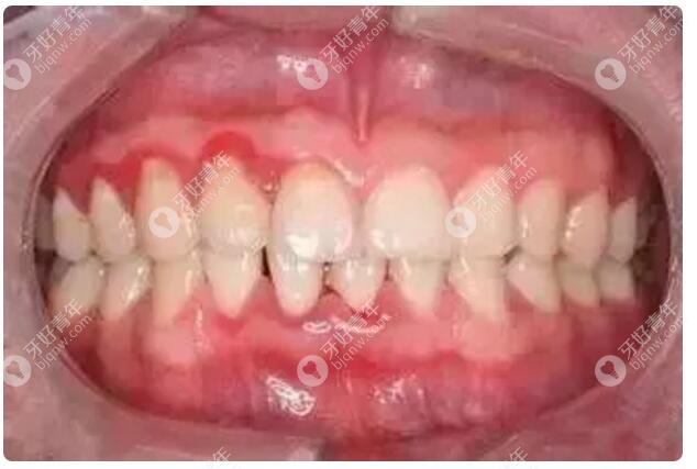 牙龈肿胀白色的脓包是什么原因造成的？真相竟是....