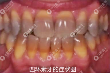 四环素牙的症状图