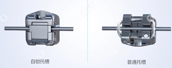 普通托槽与自锁托槽的区别