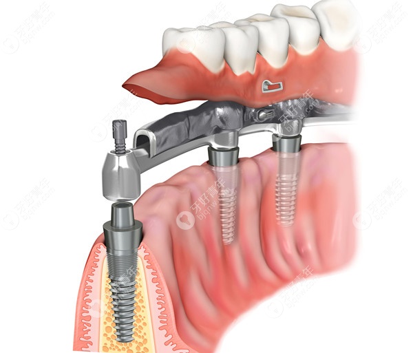 从价格和寿命判断美国皓圣和韩国登腾哪个种植体好？