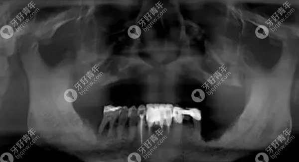 CT拍可以看道上颌牙槽骨萎缩厉害