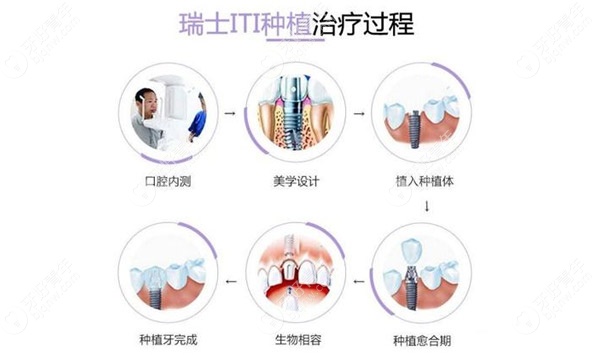 对于即刻种植而言，瑞士SIC种植体和iTI哪个更好？