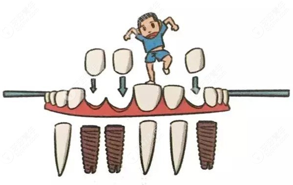 对于即刻种植而言，瑞士SIC种植体和iTI哪个更好？