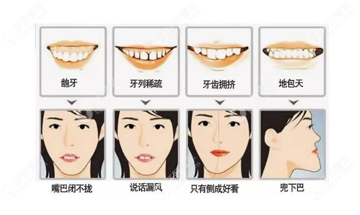 各种牙列不齐的危害