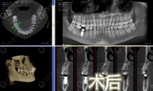 25岁的年轻人后面大牙掉了,做了颗瑞士ITI仅用了十分钟