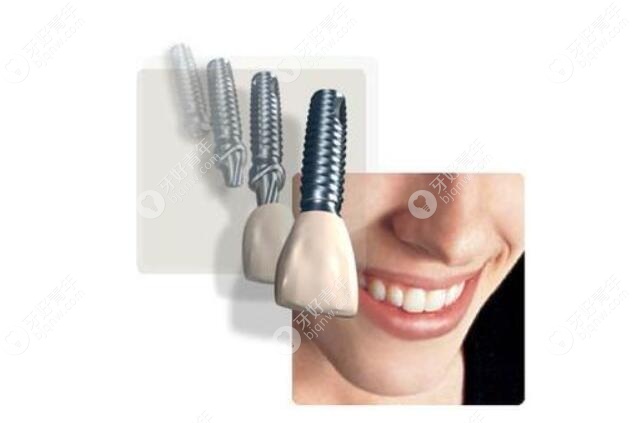 美国种植牙品牌及价格表,一键get美国都有什么种植体品牌