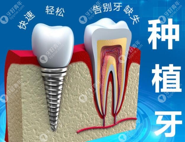 美国种植牙品牌及价格表,一键get美国都有什么种植体品牌