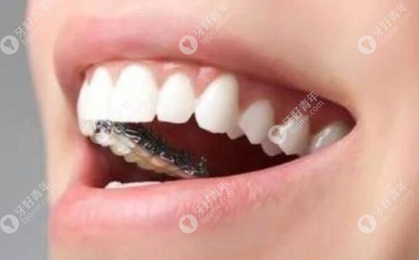 牙齿矫正的五个误区，你中了几个呢？