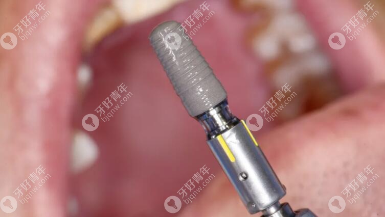 国产康盛亲水种植体和奥齿泰的价格、寿命对比后，这么选