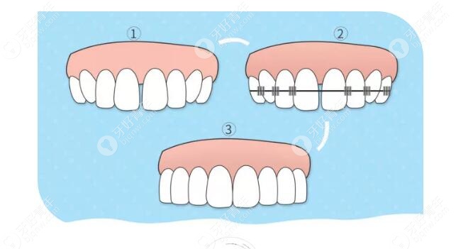 牙齿矫正的五个误区，你中了几个呢？