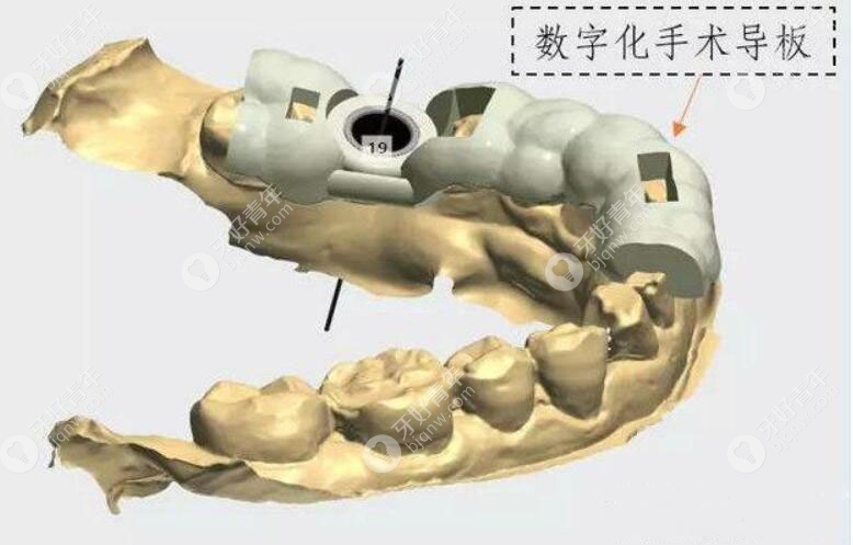 导板种植牙与普通种植牙区别是什么?数字化的优势挺明显