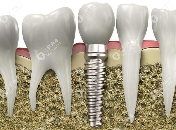 导板种植牙与普通种植牙区别是什么?数字化的优势挺明显
