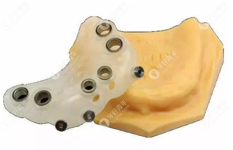 导板种植牙与普通种植牙区别是什么?数字化的优势挺明显