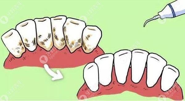 论手工洗牙和超声波洗牙的区别,消灭牙结石选哪个更好