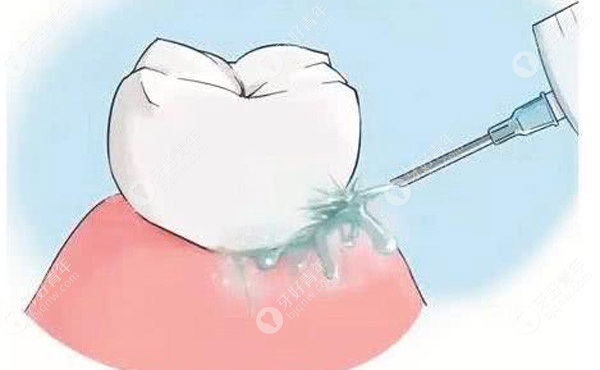 论手工洗牙和超声波洗牙的区别,消灭牙结石选哪个更好