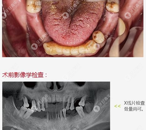 下半口牙齿缺失种植前的照片