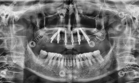 上颌牙槽骨不足做allon6即刻负重后的CT片