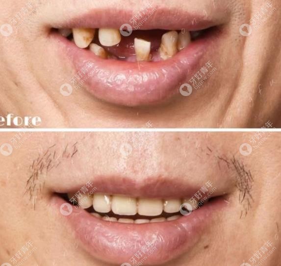 50岁牙齿都松了怎么办,全口即刻负重修复手术来帮忙