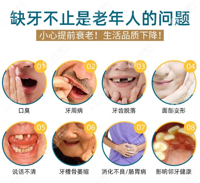 广州中家医家庭口腔的进口种植牙一颗价格仅4888元起