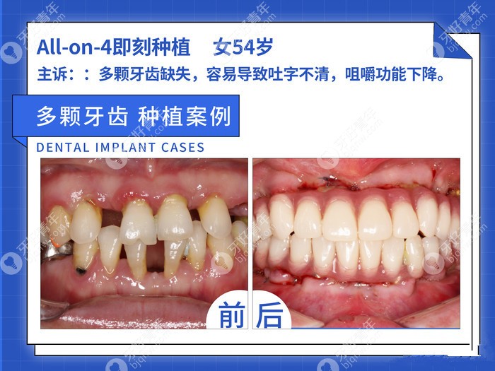 all-on-4全口种植牙当天就装上牙冠,分享妈妈的种牙经验给你
