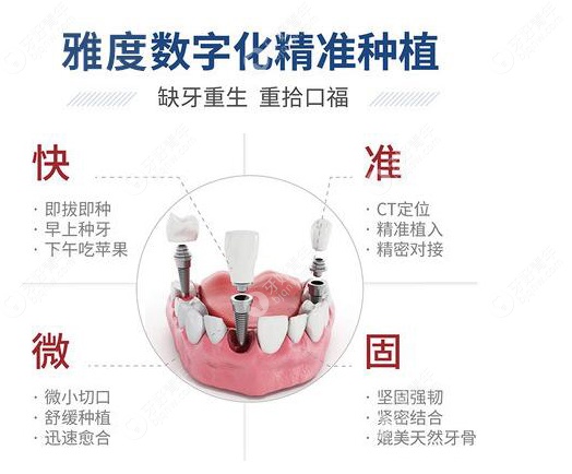 雅度口腔的4D种植牙技术