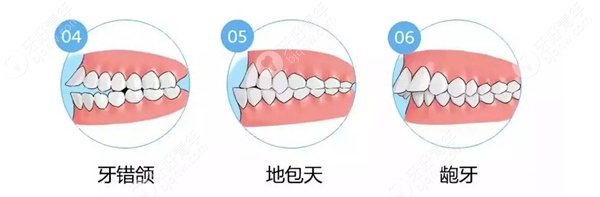 牙齿的各类不整齐表现