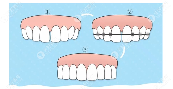 传统金属矫治器整牙过程