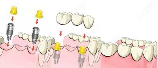 种植牙的详细过程图