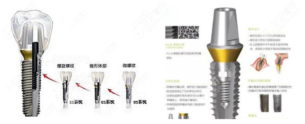 韩国登腾种植牙和奥齿泰对比