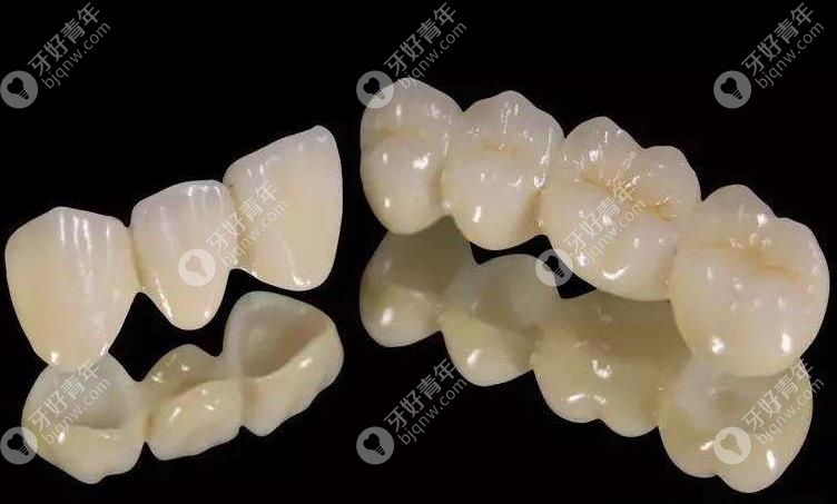 全瓷牙修复外观