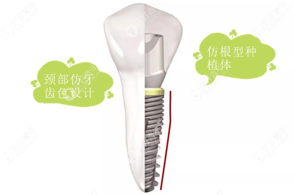 植体仿根型设计，颈部仿牙齿色设计