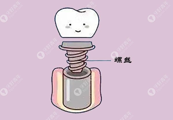 基台与种植体连接产生松动