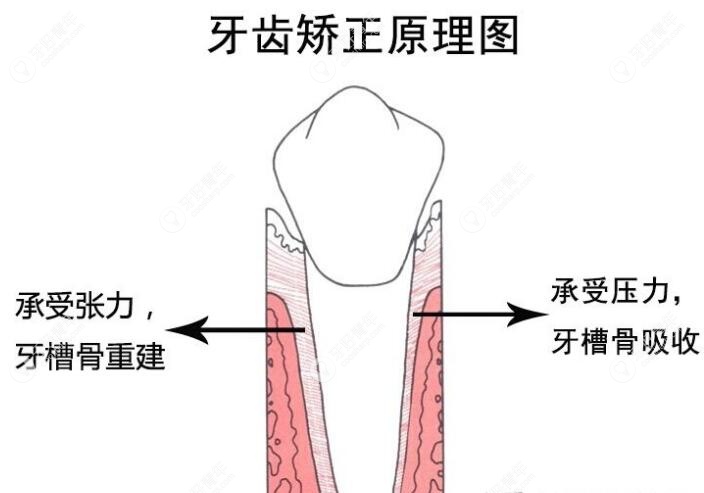 第1次牙齿矫正反弹可以做二次矫正吗