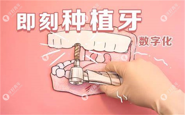 全口即刻种植牙费用
