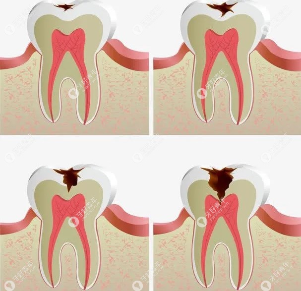为啥有人宁愿虫牙继续蛀也不愿意补牙