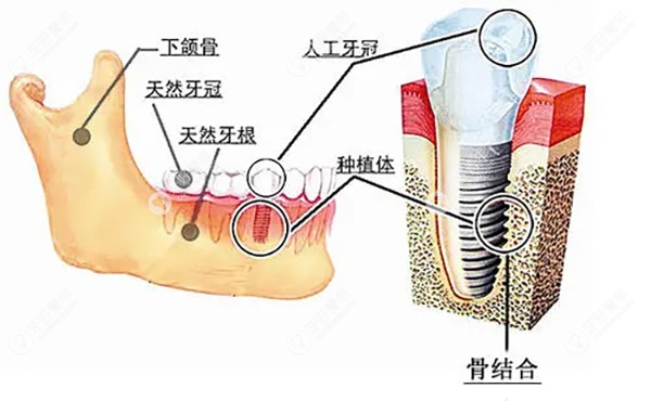 门牙适合做种植牙吗
