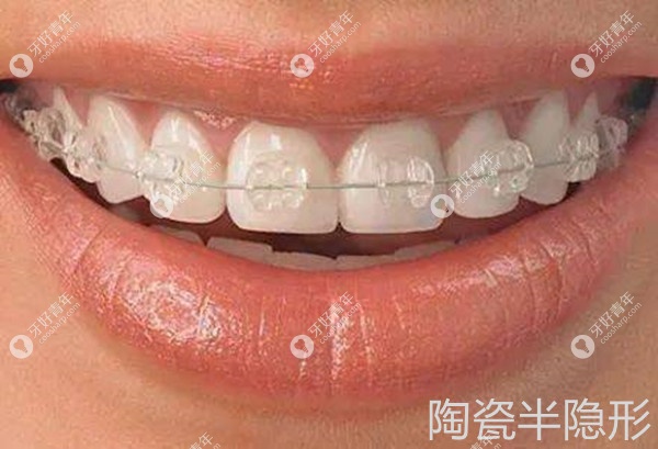陶瓷半隐形托槽多少钱