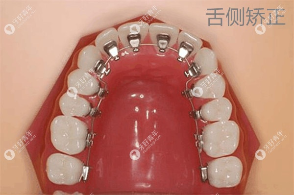 舌侧隐形矫正收费标准