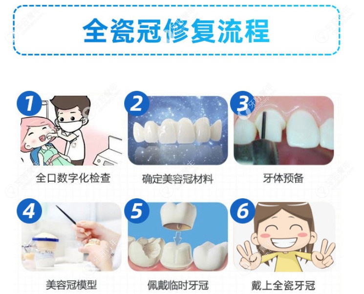 全瓷牙冠的修复流程了解下