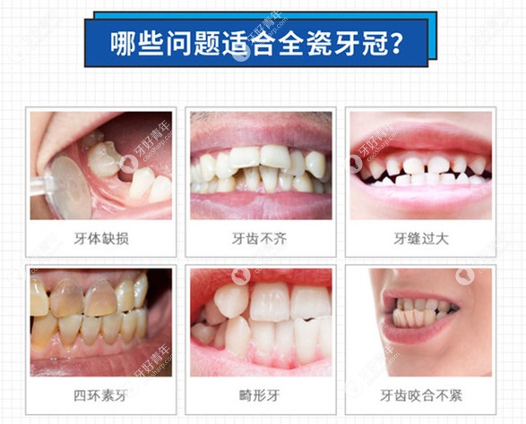 来看看全瓷牙冠的适应症有哪些