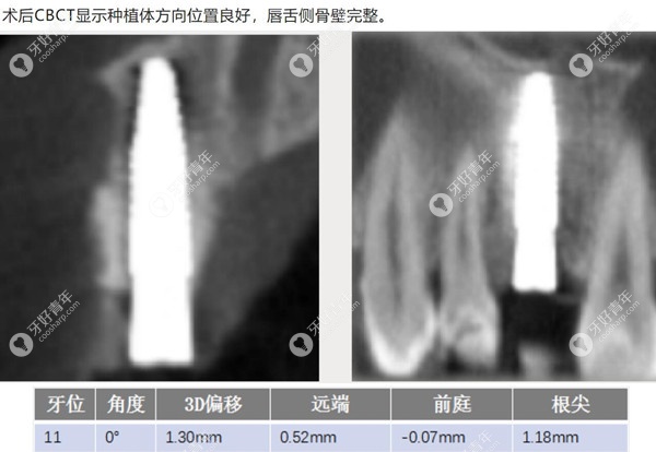 前牙美学区做瑞士ITI 骨水平BLT种植牙的过程