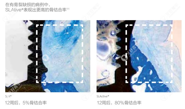 亲水型种植体好的快