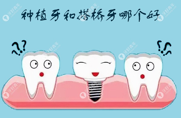 种植牙和搭桥牙哪个好