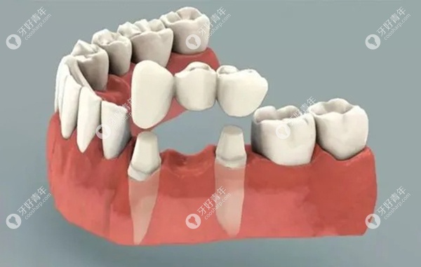 搭桥牙修复方式