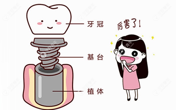 种植牙修复方式
