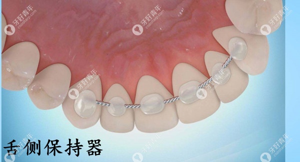  舌侧固定牙齿保持器费用